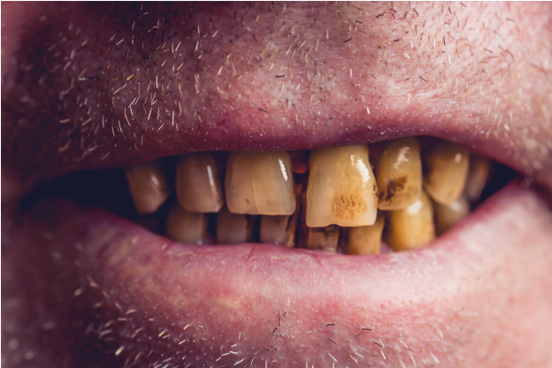 Beispiel Zahn-Sarkopenie1