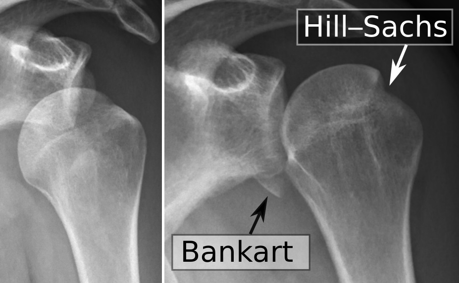 Links eine ist eine Auskuglung nach vorne auf dem Röntgenbild sichtbar. Rechts sieht man eine Hill-Sachs-Läsion (die Delle im Schulterkopf) und eine Bankart-Läsion (Fraktur am unteren Ende der Schulterpfanne).