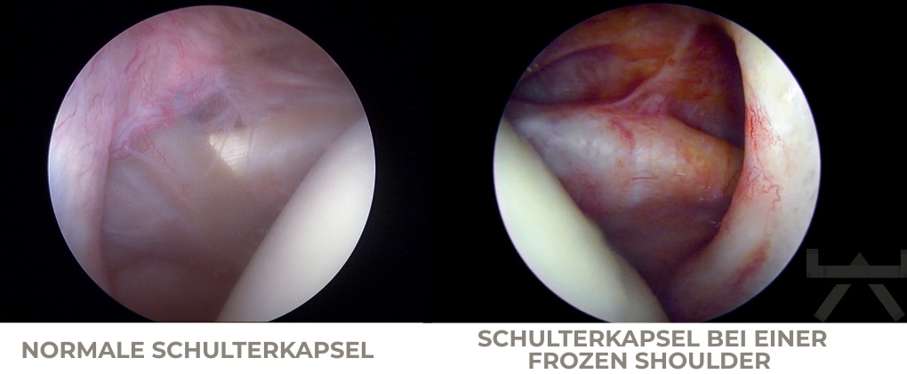 Abbildung 1: Schulterkapsel normal und mit Frozen shoulder (Myokraft)
