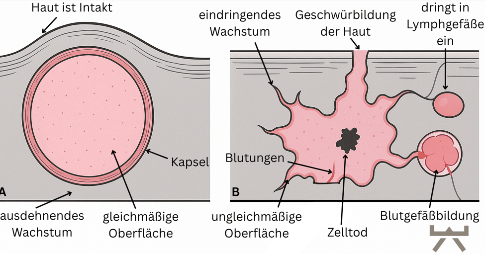 Abbildung 1: Krebsformen (Myokraft in Anlehnung an Damjanov, 2000)